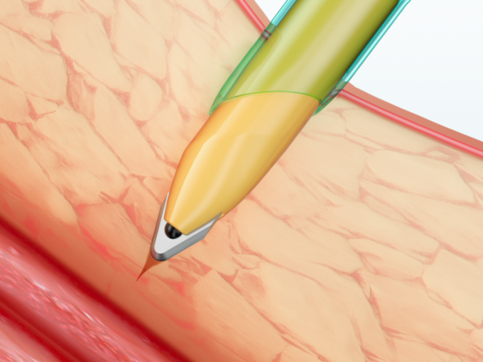 블레이드와 복강경 기구 버릴 수 있는 투관침 삽입관 1