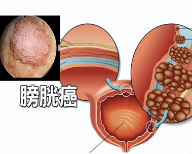 에 대한 최신 회사 뉴스 방광암의 임상 진단과 생리학적 치료  0